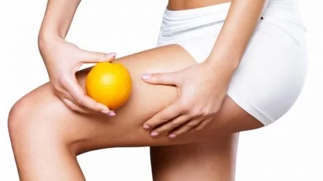 Cellulite