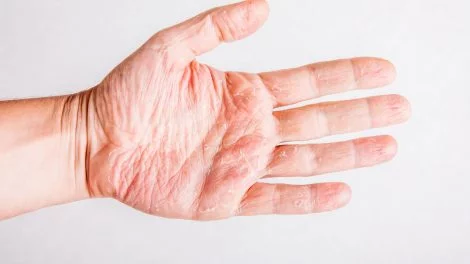 Neurodermitis