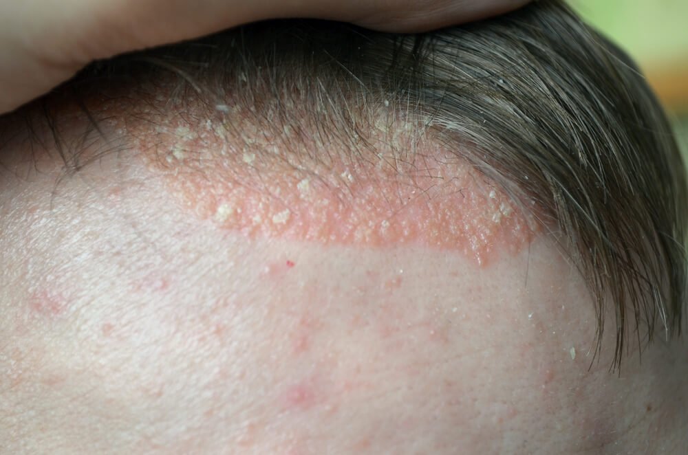 Spondylarthrose Ursachen Symptome Und Therapie Rundumgesund de khmer