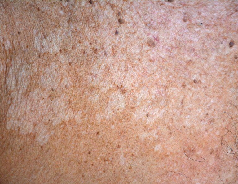 kleienpilzflechte rücken bilder