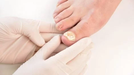 Nagelpilz