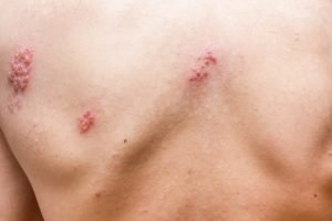 Gürtelrose (Herpes zoster)