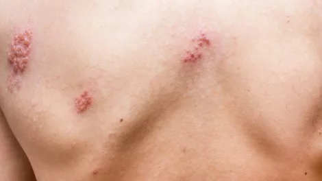Gürtelrose (Herpes zoster)