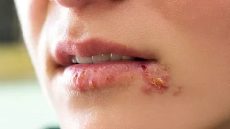 Lippenherpes