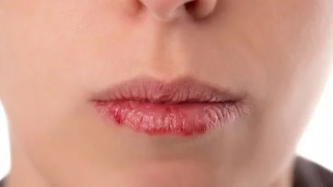 Ursachen für spröde Lippen: So hilft die Behandlung mit Globuli