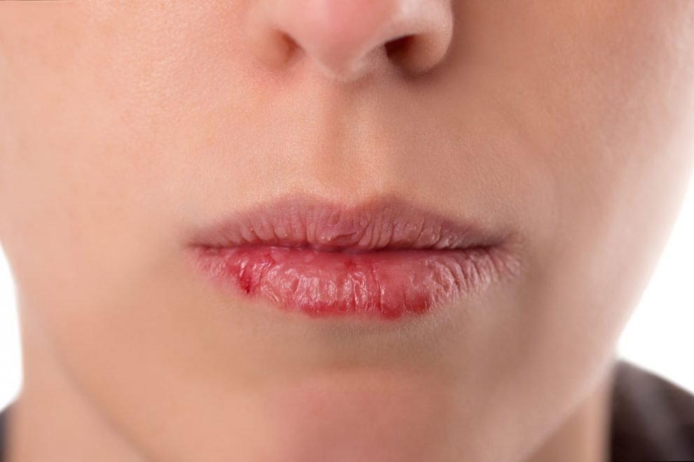 Ursachen für spröde Lippen: So hilft die Behandlung mit Globuli