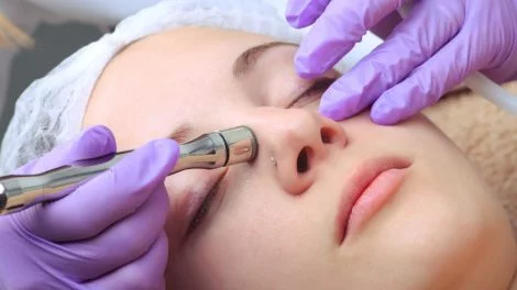 Dremabrasion gegen Aknenarben - Ablauf, Kosten und Risiken