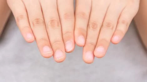 Brüchige Fingernägel