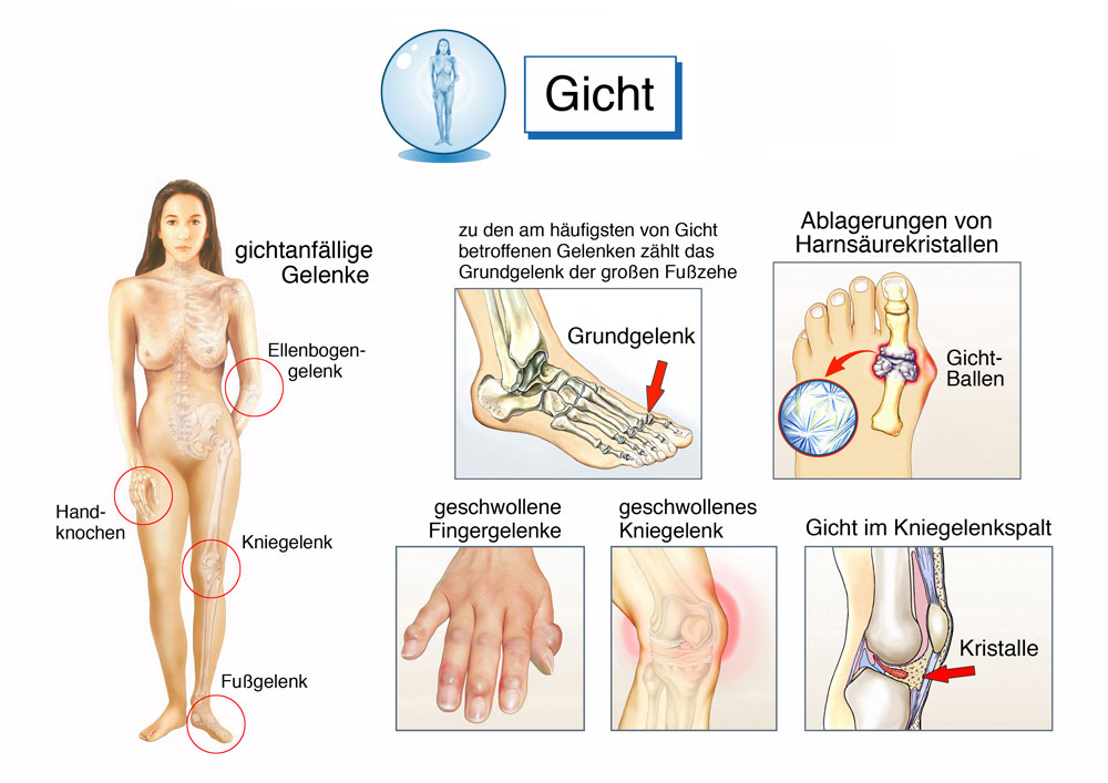 © Henrie / stock.adobe.com Übersicht über Gicht