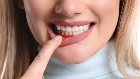 Hausmittel gegen Zahnfleischentzündungen