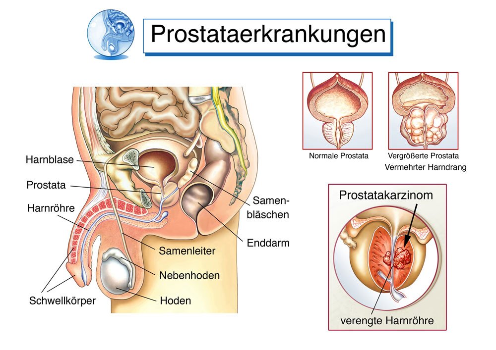 © Henrie / stock.adobe.com Prostata Erkrankungen