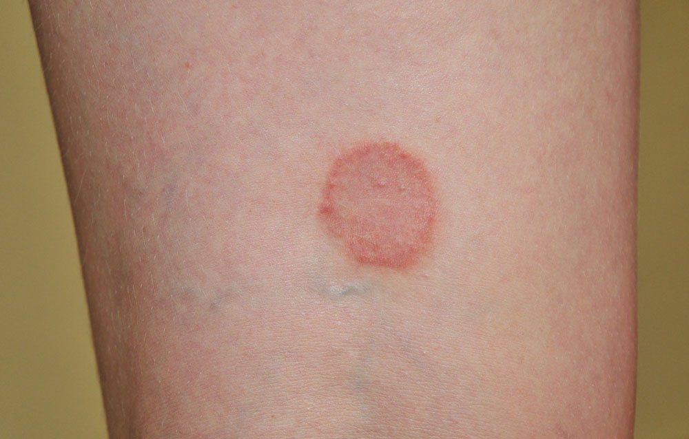 Ringelflechte Ursachen Symptome Und Behandlung Rundumgesund De