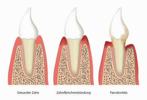 Zahnfleischentzündung