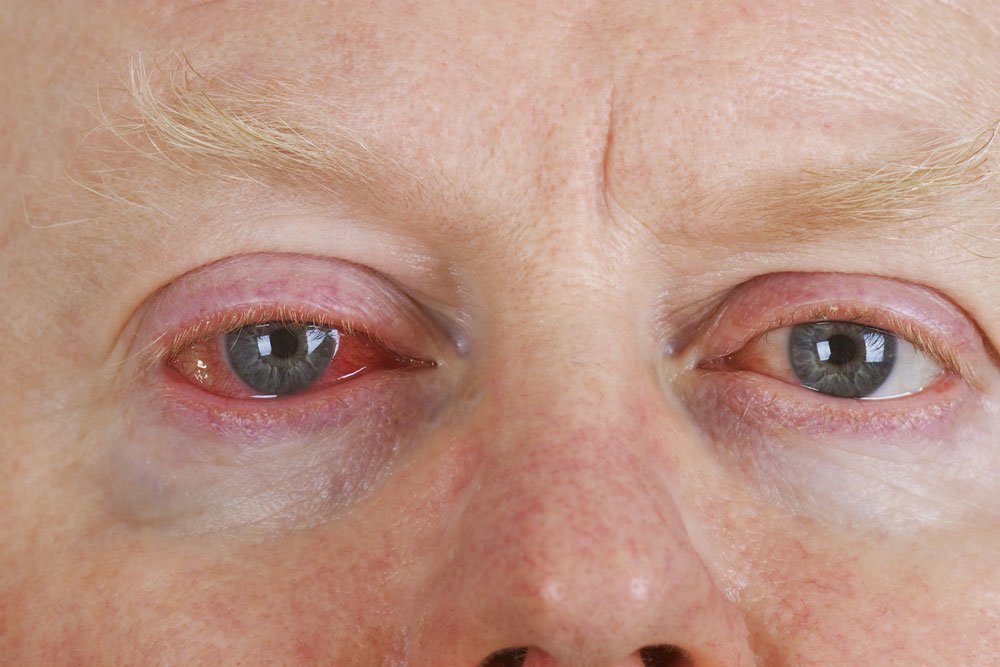 Toxoplasmose Ursachen, Symptome und Therapie rundumgesund.de