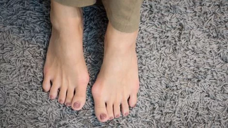 Hallux valgus