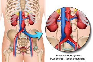 Aneurysma