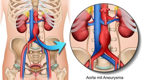 Aneurysma