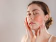 Rosacea
