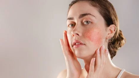 Rosacea