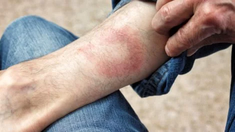 Borreliose