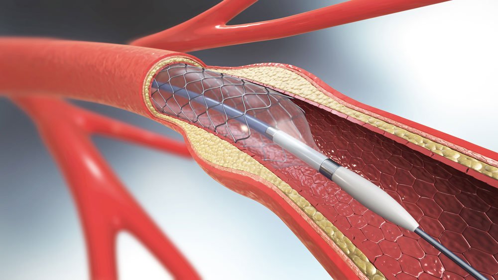 gefäßchirurgie stents therapie