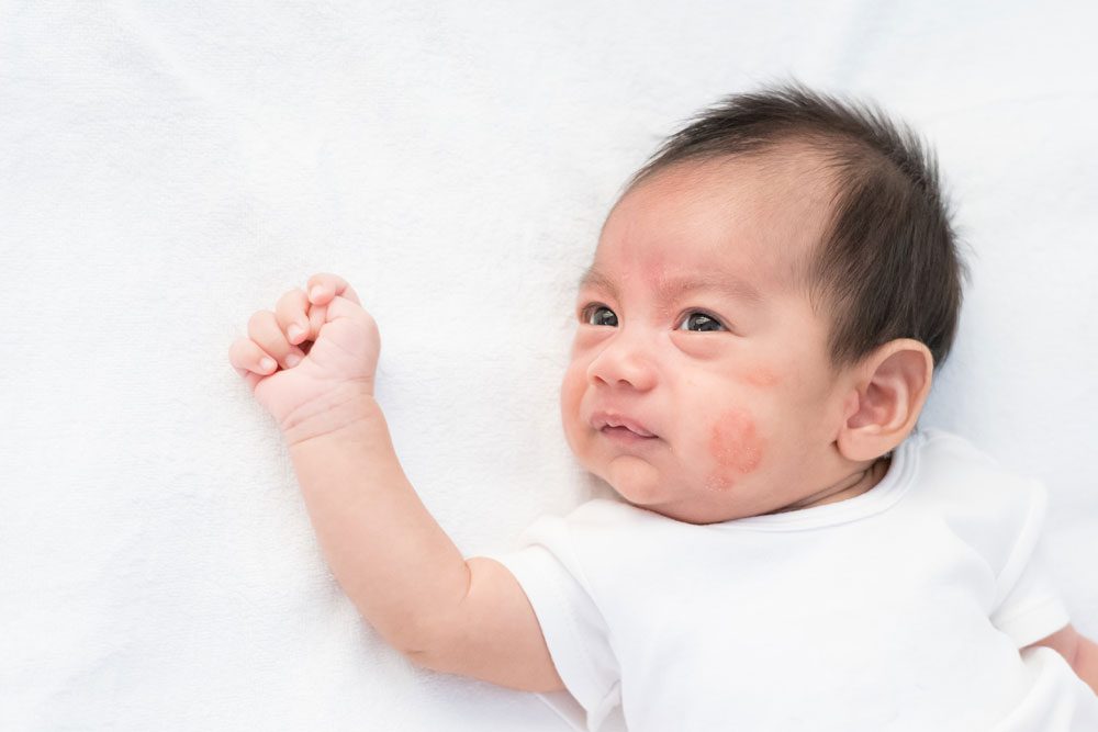 Baby mit Neurodermitis im Gesicht.