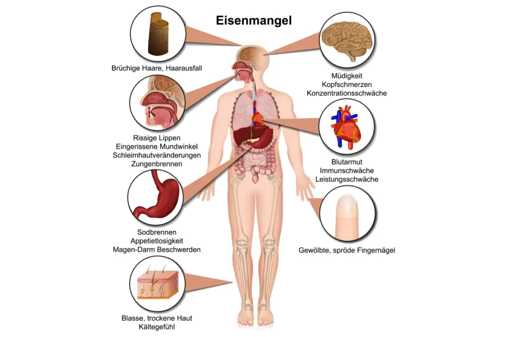 Symptome Eisenmangel