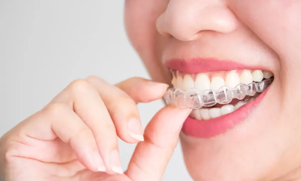 Invisalign Zahnspange