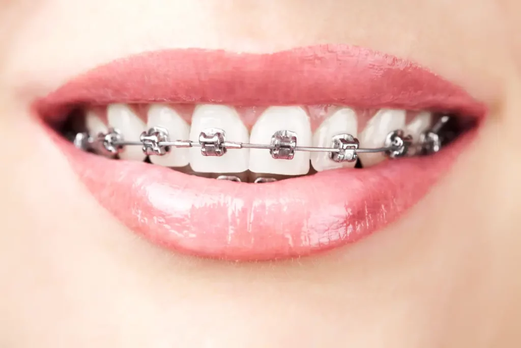 Zahnspange mit Metallbrackets