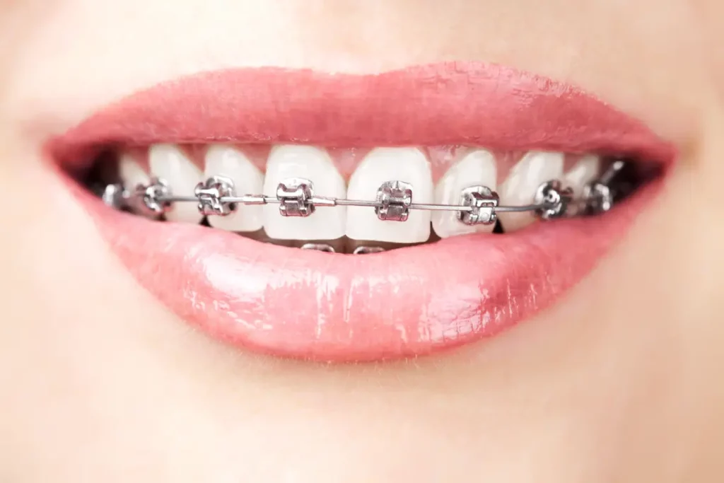 Zahnspange aus Metall Zahnspange mit Metallbrackets