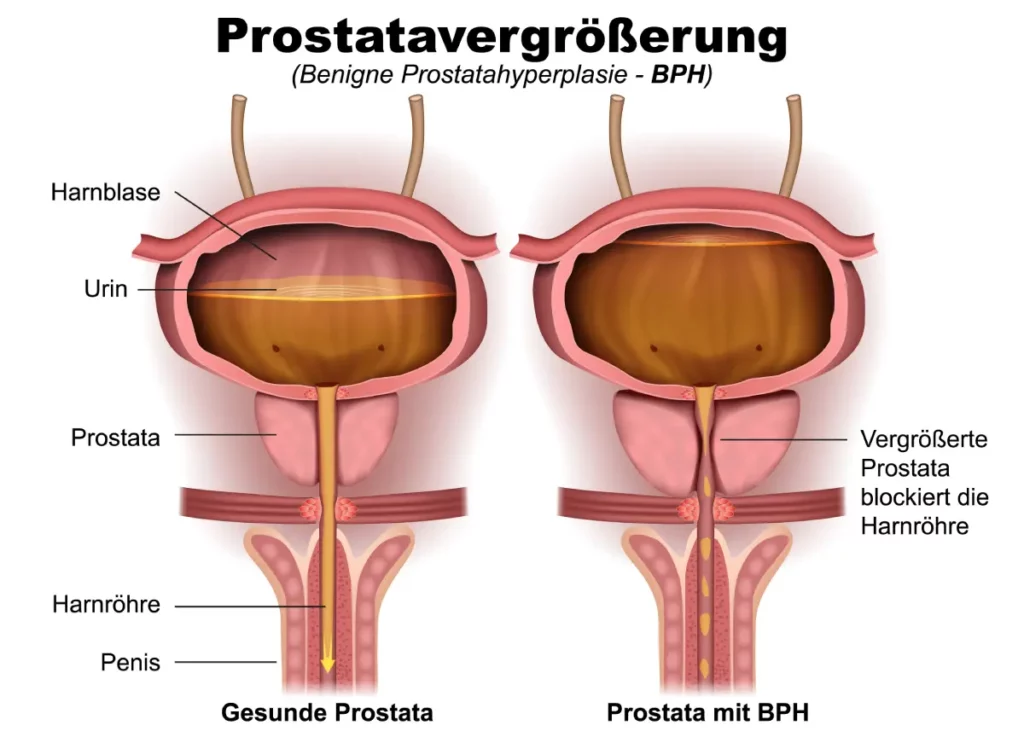 Bildliche Darstellung einer Prostatavergrößerung Prostatavergrößerung: Ursachen, Symptome & Tipps