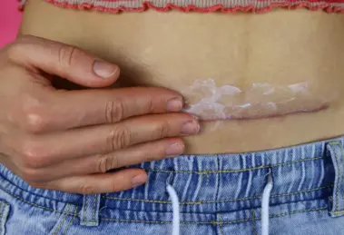 Narbenpflege nach OP – Tipps für eine optimale Wundheilung