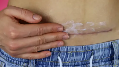 Narbenpflege nach OP – Tipps für eine optimale Wundheilung